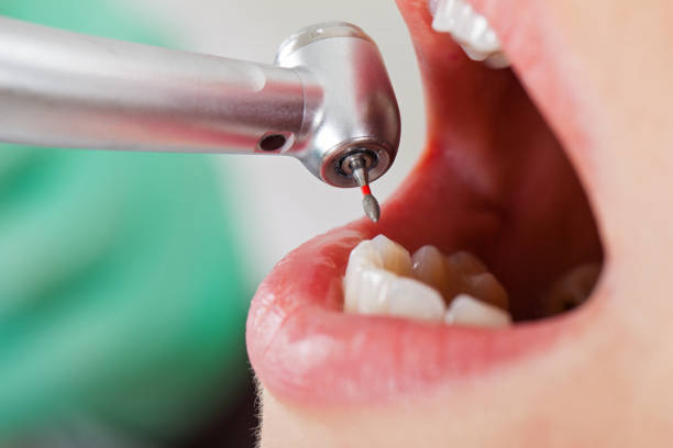 Best Emergency Dental Care for Broken or Chipped Teeth in Covina, CA